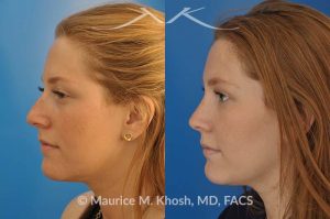 Photo of a patient before and after a procedure. Rhinoplasty for crooked nose - 26 year old with crooked nose to the right side and a small hump. She was seeking rhinoplasty in Manhattan to straighten the nose remove a hump. She was treated with closed rhinoplasty which allowed reduction of the hump, a cartilage spreader graft on the left side, and a columellar strut.