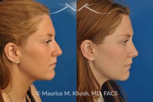 Photo of a patient before and after a procedure. Rhinoplasty for crooked nose - 26 year old with crooked nose to the right side and a small hump. She was seeking rhinoplasty in Manhattan to straighten the nose remove a hump. She was treated with closed rhinoplasty which allowed reduction of the hump, a cartilage spreader graft on the left side, and a columellar strut.