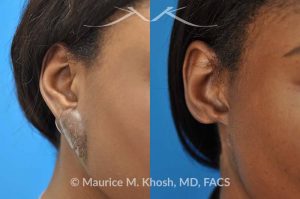 Photo of a patient before and after a procedure. Recurrent keloid of ear - This 24 year old had a keloid of the right which had been excised three times in the past. Each time the keloid recurred and became larger. She was treated with surgical excision followed by radiation therapy. The pictures depict a one year post operative result.