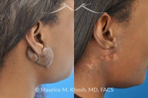 Photo of a patient before and after a procedure. Recurrent keloid of ear - This 24 year old had a keloid of the right which had been excised three times in the past. Each time the keloid recurred and became larger. She was treated with surgical excision followed by radiation therapy. The pictures depict a one year post operative result.