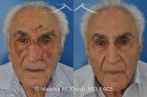 Photo of a patient before and after a procedure. Broken nose repair - This gentleman suffered a nose fracture when he tripped and fell. The nose fracture was repaired in the office under local anesthesia. Before and after pictures of nose fracture repair.