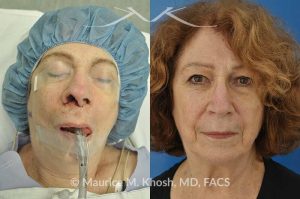 Photo of a patient before and after a procedure. Skin cancer repair involving the nostril - Patient had undergone skin cancer removal from the nose and the right nostril. She had lost skin and cartilage resulting in loss of nasal tip support. She was reconstructed with a composite graft of cartilage and mucosa (skin inside the nose). Before and after pictures of skin cancer repair.