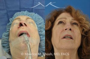 Photo of a patient before and after a procedure. Skin cancer repair involving the nostril - Patient had undergone skin cancer removal from the nose and the right nostril. She had lost skin and cartilage resulting in loss of nasal tip support. She was reconstructed with a composite graft of cartilage and mucosa (skin inside the nose). Before and after pictures of skin cancer repair.