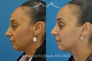 Photo of a patient before and after a procedure. Rhinoplasty to remove hump - This young lady with Hispanic ethnicity was interested in removing a small hump in the nose. Rhinoplasty was performed through a closed (endonasal) approach.