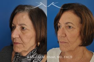Photo of a patient before and after a procedure. Osteoma Removal - 68 year old lady interested in osteoma removal in Manhattan. Problem: Hard, round, raised mass underneath the forehead skin. Procedure: Osteoma removal as an office procedure, under local anesthesia.