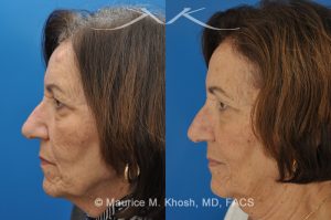 Photo of a patient before and after a procedure. Osteoma Removal - 68 year old lady interested in osteoma removal in Manhattan. Problem: Hard, round, raised mass underneath the forehead skin. Procedure: Osteoma removal as an office procedure, under local anesthesia.