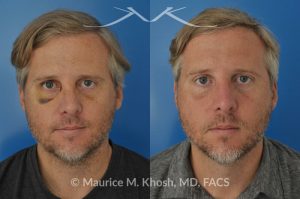 Photo of a patient before and after a procedure. Repair of broken nose