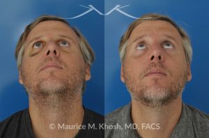 Photo of a patient before and after a procedure. Repair of broken nose