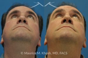 Photo of a patient before and after a procedure. Right eye socket fracture repaired with bone graft