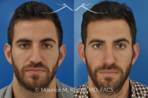 Photo of a patient before and after a procedure. Crooked nose with droopy tip