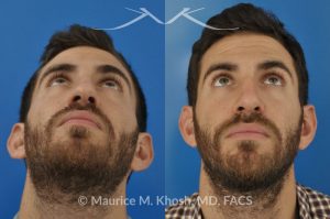 Photo of a patient before and after a procedure. Crooked nose with droopy tip