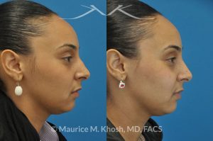 Photo of a patient before and after a procedure. Rhinoplasty to remove hump - This young lady with Hispanic ethnicity was interested in removing a small hump in the nose. Rhinoplasty was performed through a closed (endonasal) approach.