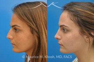 Photo of a patient before and after a procedure. Natural result after rhinoplasty for a nose hump