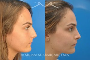 Photo of a patient before and after a procedure. Natural result after rhinoplasty for a nose hump