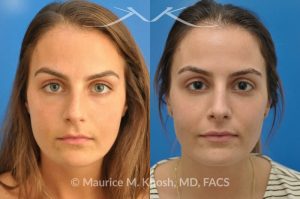 Photo of a patient before and after a procedure. Natural result after rhinoplasty for a nose hump