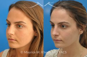 Photo of a patient before and after a procedure. Natural result after rhinoplasty for a nose hump