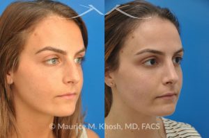 Photo of a patient before and after a procedure. Natural result after rhinoplasty for a nose hump