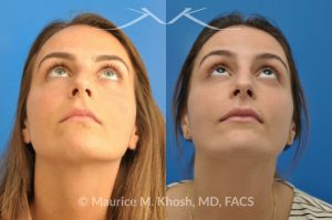 Photo of a patient before and after a procedure. Natural result after rhinoplasty for a nose hump