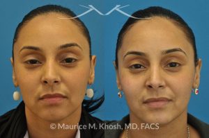 Photo of a patient before and after a procedure. Rhinoplasty to remove hump - This young lady with Hispanic ethnicity was interested in removing a small hump in the nose. Rhinoplasty was performed through a closed (endonasal) approach.