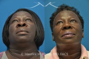 Photo of a patient before and after a procedure. Rhinoplasty to narrow the nostrils and refine the tip