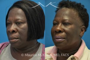 Photo of a patient before and after a procedure. Rhinoplasty to narrow the nostrils and refine the tip