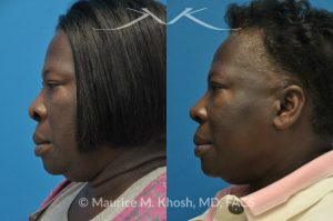 Photo of a patient before and after a procedure. Rhinoplasty to narrow the nostrils and refine the tip