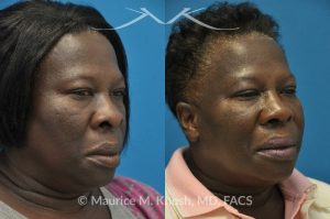 Photo of a patient before and after a procedure. Rhinoplasty to narrow the nostrils and refine the tip