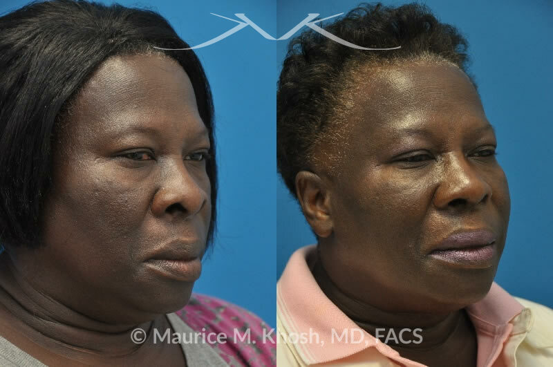 African American nose surgery before & after.