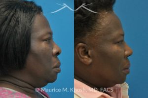 Photo of a patient before and after a procedure. Rhinoplasty to narrow the nostrils and refine the tip