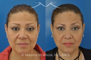 Photo of a patient before and after a procedure. Removal of skin cancer in the tip of the nose with repair - before and after photos.