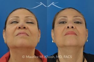 Photo of a patient before and after a procedure. Removal of skin cancer in the tip of the nose with repair - before and after photos.