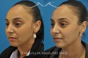 Photo of a patient before and after a procedure. Rhinoplasty to remove hump - This young lady with Hispanic ethnicity was interested in removing a small hump in the nose. Rhinoplasty was performed through a closed (endonasal) approach.