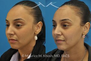 Photo of a patient before and after a procedure. Rhinoplasty to remove hump - This young lady with Hispanic ethnicity was interested in removing a small hump in the nose. Rhinoplasty was performed through a closed (endonasal) approach.