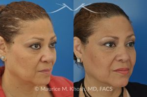 Photo of a patient before and after a procedure. Removal of skin cancer in the tip of the nose with repair - before and after photos.