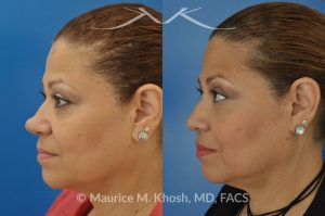 Photo of a patient before and after a procedure. Removal of skin cancer in the tip of the nose with repair