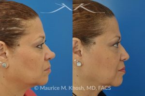 Photo of a patient before and after a procedure. Removal of skin cancer in the tip of the nose with repair
