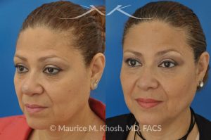 Photo of a patient before and after a procedure. Removal of skin cancer in the tip of the nose with repair