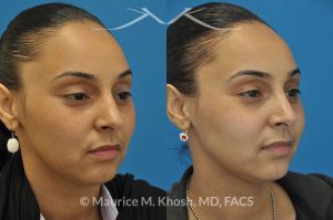 Photo of a patient before and after a procedure. Rhinoplasty to remove hump - This young lady with Hispanic ethnicity was interested in removing a small hump in the nose. Rhinoplasty was performed through a closed (endonasal) approach.