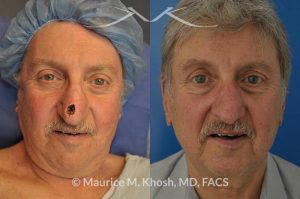 Photo of a patient before and after a procedure. Repair of Moh's defect of the lower nose after removal of basal cell cancer of skin. Bilobed flap technique - before and after photos.