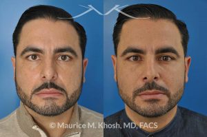 Photo of a patient before and after a procedure. Rhinoplasty for subtle reduction of the dorsal hump and tip elevation