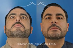 Photo of a patient before and after a procedure. Rhinoplasty for subtle reduction of the dorsal hump and tip elevation