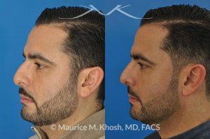 Photo of a patient before and after a procedure. Rhinoplasty for subtle reduction of the dorsal hump and tip elevation