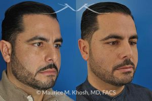 Photo of a patient before and after a procedure. Rhinoplasty for subtle reduction of the dorsal hump and tip elevation