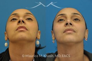 Photo of a patient before and after a procedure. Rhinoplasty to remove hump - This young lady with Hispanic ethnicity was interested in removing a small hump in the nose. Rhinoplasty was performed through a closed (endonasal) approach.