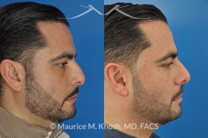 Photo of a patient before and after a procedure. Rhinoplasty for subtle reduction of the dorsal hump and tip elevation