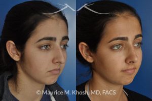 Photo of a patient before and after a procedure. Rhinoplasty for tip elevation, lowering of nasal hump, and narrowing the nasal tip