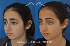 Photo of a patient before and after a procedure. Rhinoplasty for tip elevation, lowering of nasal hump, and narrowing the nasal tip