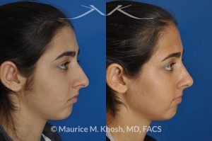 Photo of a patient before and after a procedure. Rhinoplasty for tip elevation, lowering of nasal hump, and narrowing the nasal tip