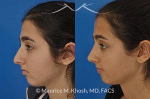 Photo of a patient before and after a procedure. Rhinoplasty for tip elevation, lowering of nasal hump, and narrowing the nasal tip