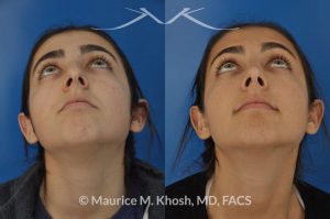 Photo of a patient before and after a procedure. Rhinoplasty for tip elevation, lowering of nasal hump, and narrowing the nasal tip